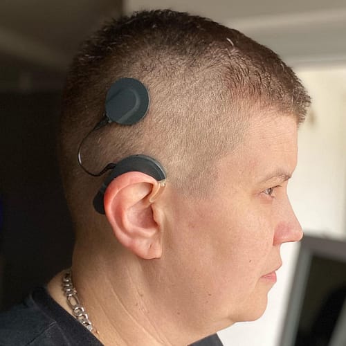 Kohlearni implant